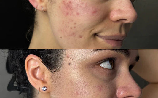 Rotlichttherapie Vorher &amp; Nachher: Bilder und Ergebnisse